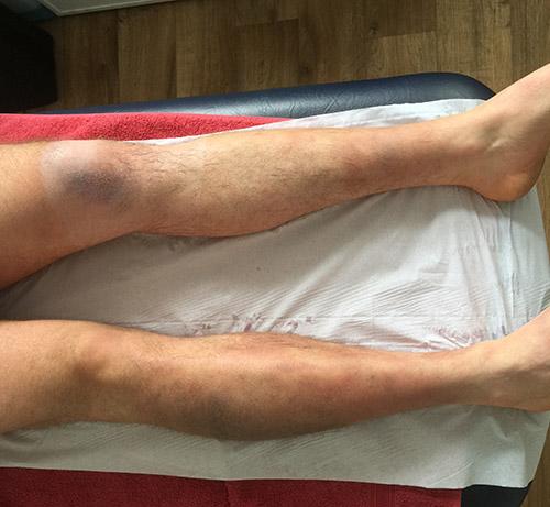 Colin Murphy legs after treatment with CryoSpa ice bath - day 3